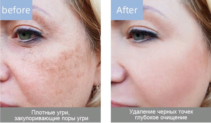 Скруббер Ультразвуковой Face Skin Cleaning Scrubber Оптом